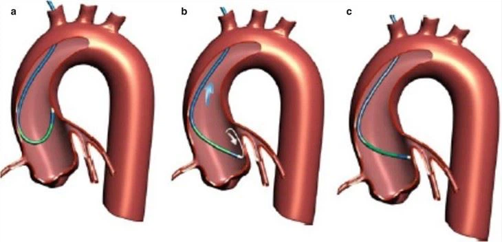 Guiding Sheath Custom